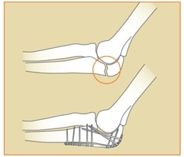 Image related to Elbow Fractures | Houston Fracture Treatment