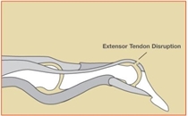 Image related to Extensor Tendon Injuries | Houston Tendon Treatment