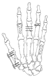 Image related to Hand Fractures | Hand Surgery Houston TX