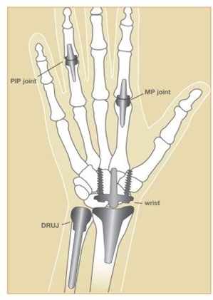 Image related to Joint Replacement Surgery | Dean Smith MD Houston TX