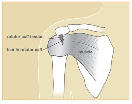 Rotator Cuff Injuries  Tendon Injuries Houston