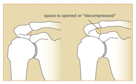 Rotator Cuff Tears Houston, TX, Tendinosis Houston, TX