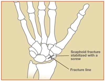 Image related to Scaphoid Fractures | Fractures and Sprains Houston TX