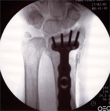 Image related to Wrist Fractures