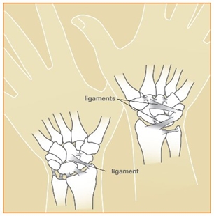 Image related to Wrist Sprains