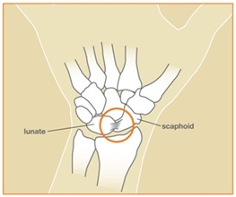 Splint Immobilization For Treatment of a Scapholunate Ligament Injury