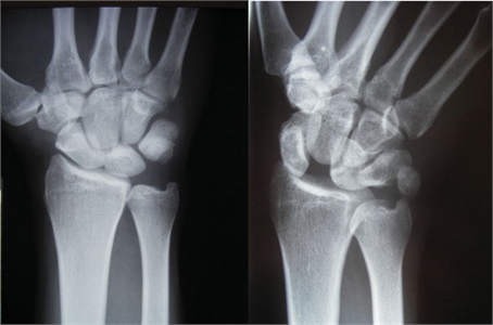 Splint Immobilization For Treatment of a Scapholunate Ligament Injury